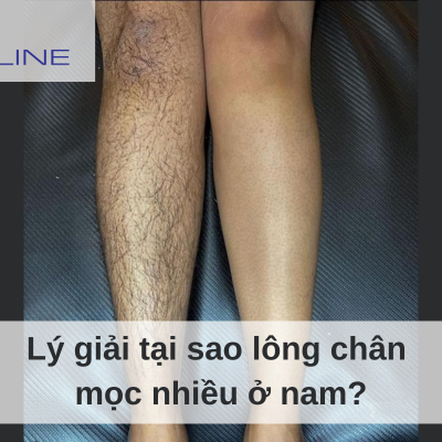 Why Do Men Have More Leg Hair?
