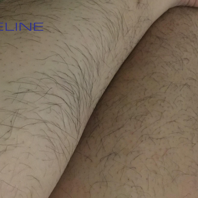 Why Do Girls Have So Much Leg Hair?