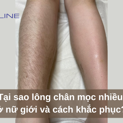 Why Do Women Have Excessive Leg Hair and How to Fix It?
