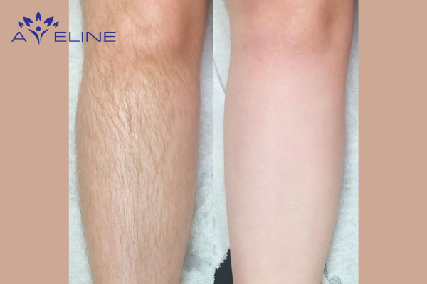 A Different Perspective on Leg Hair