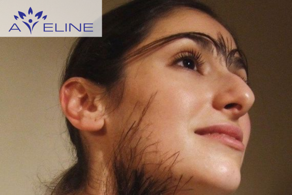 Cushing's Syndrome