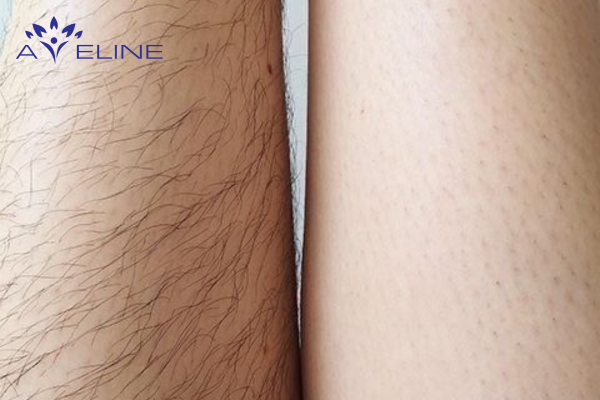 Cushing’s Syndrome