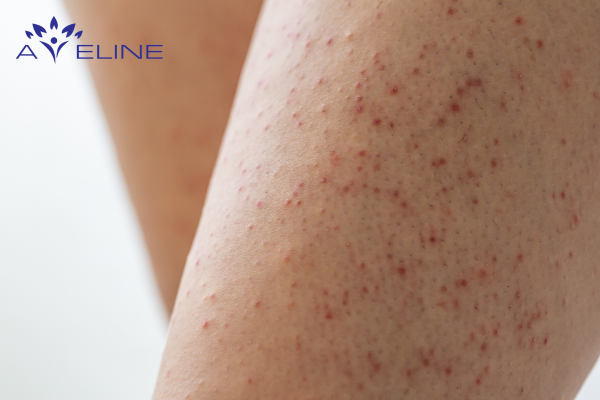 Skin Damage