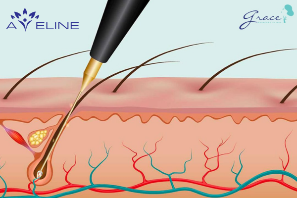 Electrolysis