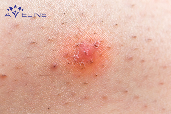 Ingrown Hairs