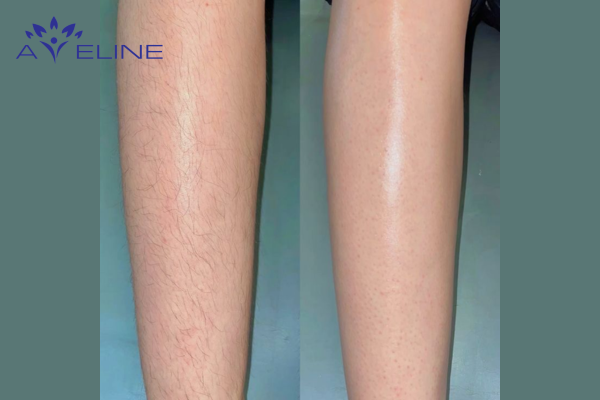 Should Men Remove Their Leg Hair?