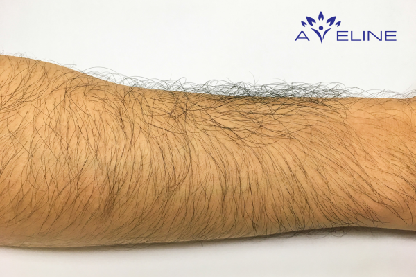 What is arm hair?