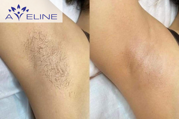 Why Is Underarm Hair Important